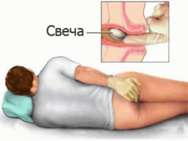Применение ректальных свечей