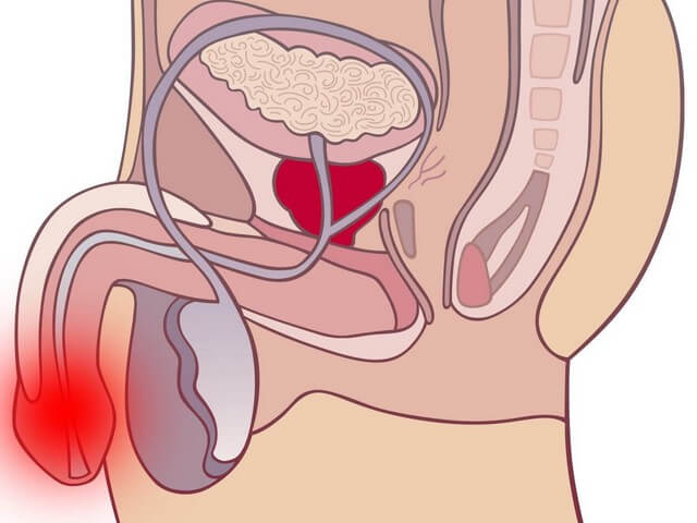Зуд при простате