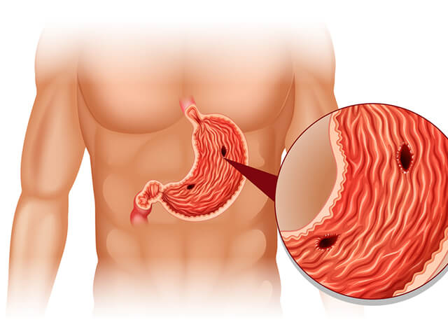 Язва желудка