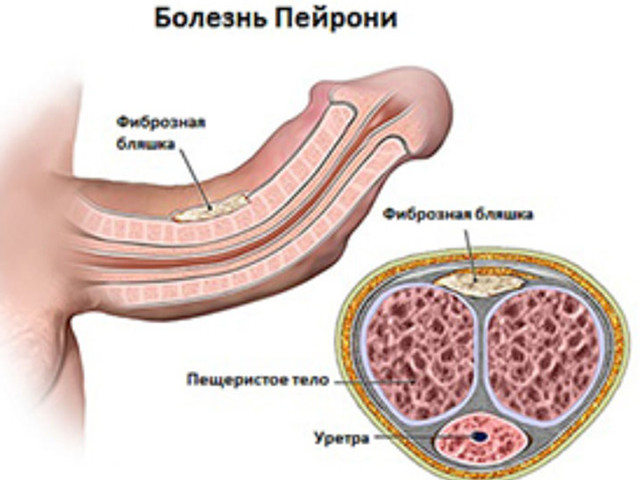 Болезнь Пейрони
