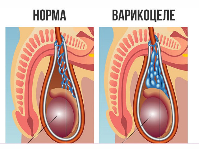 Заболевание варикоцеле