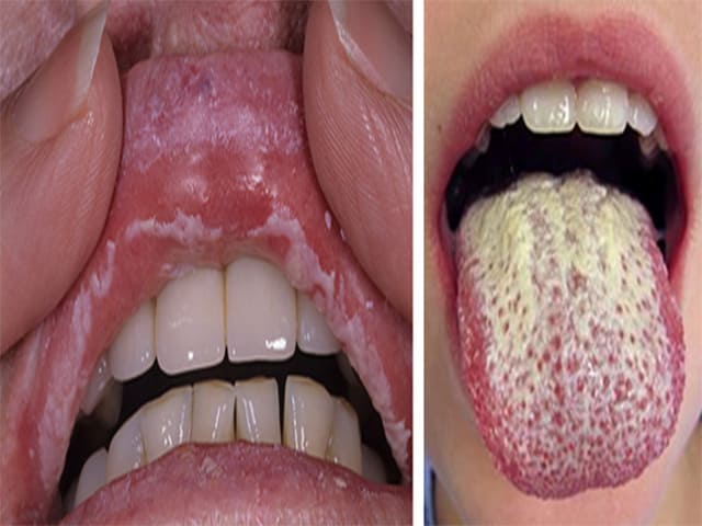 Хроническая генерализованная форма