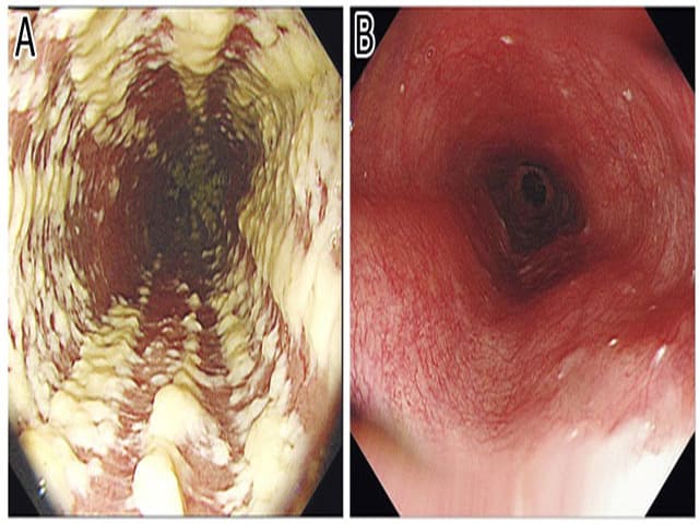 Заболевание в кишечнике Кандидоз кишечника