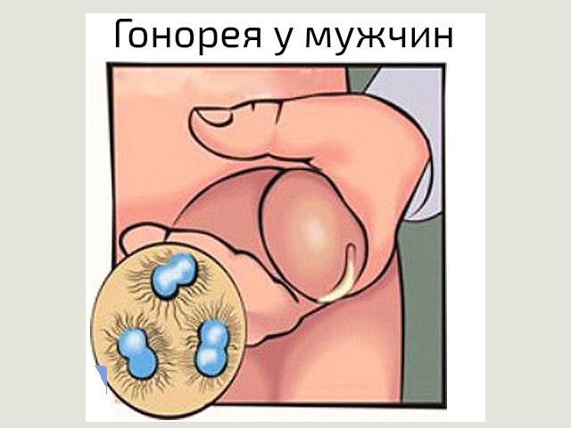 Инфекционное заболевание