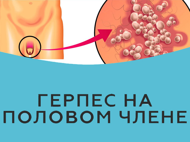 Герпес на половом члене