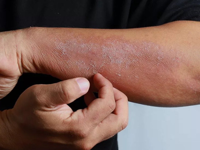 Кожное заболевание 