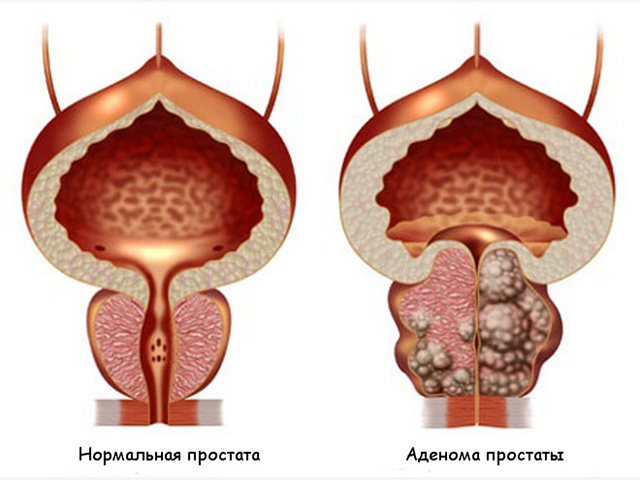 Схема заболевания
