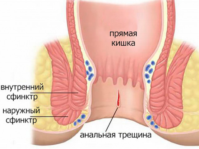 Анальная трещина Схематический рисунок