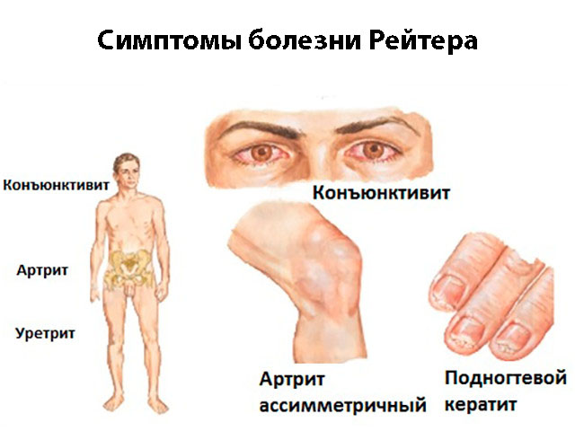 Симптомы болезни Рейтера Схематический рисунок